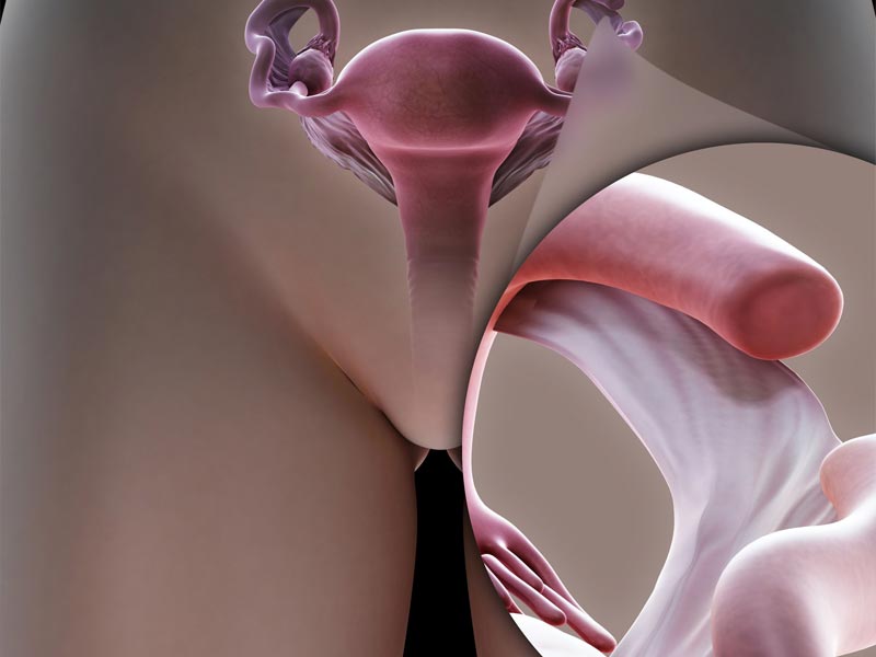 Απολίνωση Σαλπίγγων (Στείρωση) μετά τον Τοκετό - Postpartum Sterilization