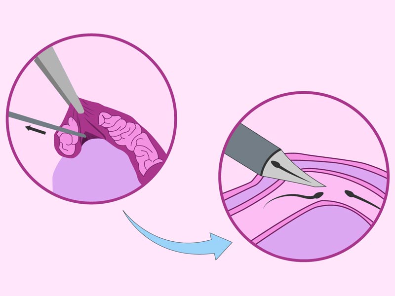 Μέθοδος MESA ( Microscopic Epididymal Sperm Aspiration)