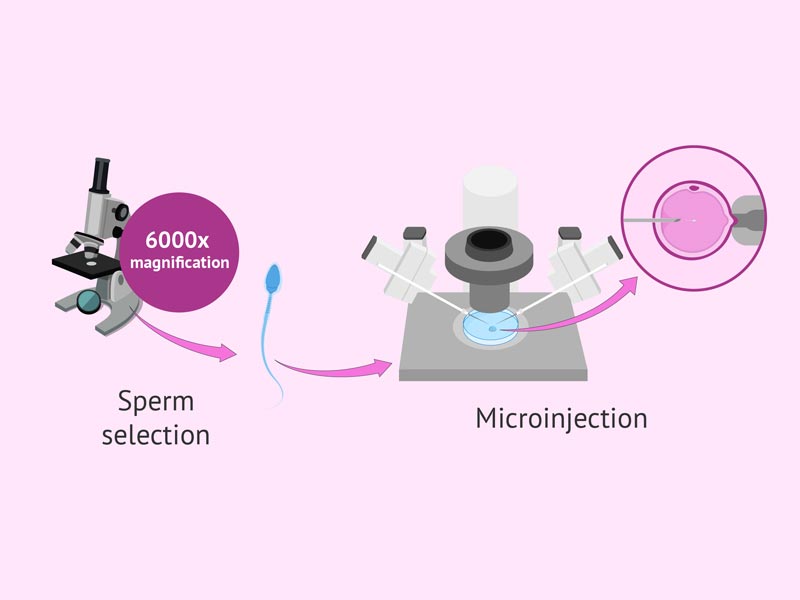 Μέθοδος IMSI (Intracytoplasmic Morphologically Selected Sperm Injection)