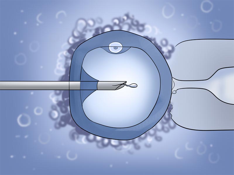 Μέθοδος ICSI (Intracytoplasmic Sperm Injection)