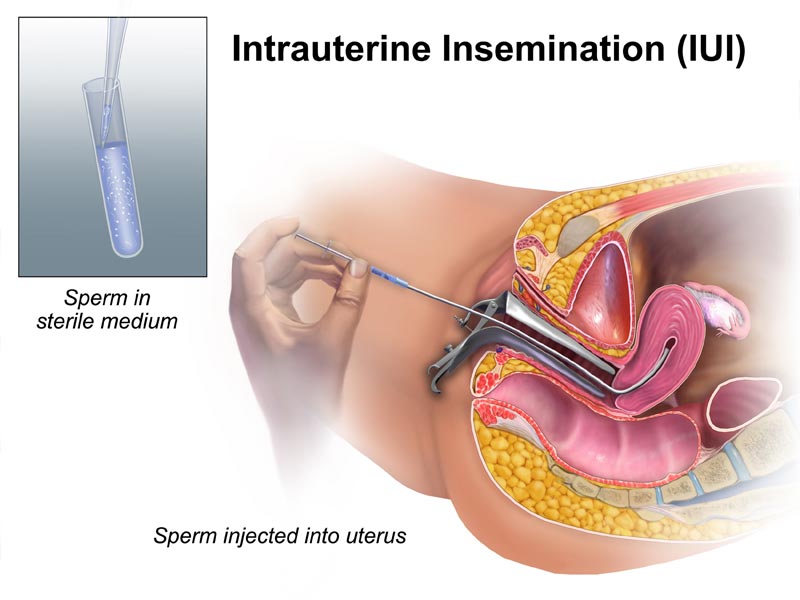 Ενδομήτρια Σπερματέγχυση - Intrauterine insemination (IUI)