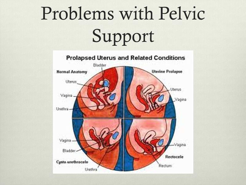 Προβλήματα στήριξης του πυελικού εδάφους - Pelvic Support Problems