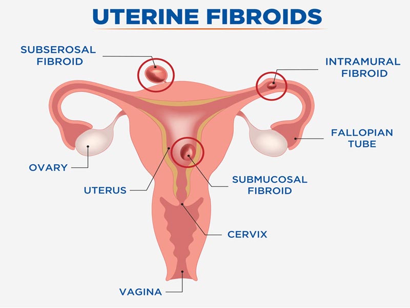 Ινομυώματα Μήτρας - Uterine Fibroids