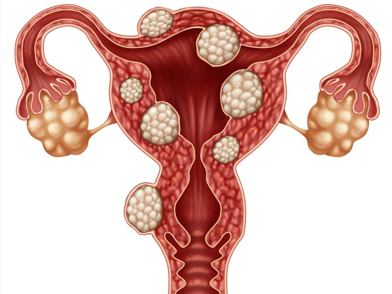 Κύστεις των Ωοθηκών - Ovarian Cysts