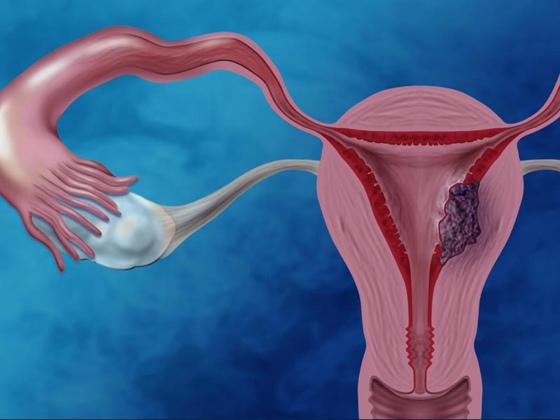 Καρκίνος του Ενδομητρίου - Endometrial Cancer