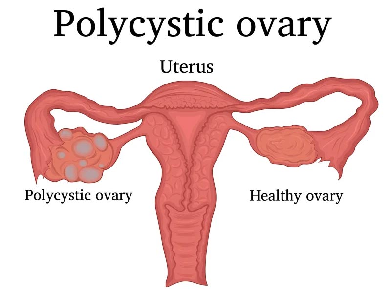 Σύνδρομο Πολυκυστικών Ωοθηκών (ΣΠΩ) - Polycystic Ovary Syndrome (PCOS)