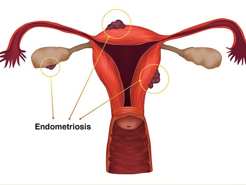 Ενδομητρίωση - Endometriosis