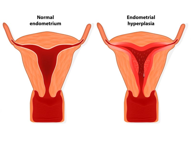 Υπερπλασία του Ενδομητρίου - Endometrial Hyperplasia