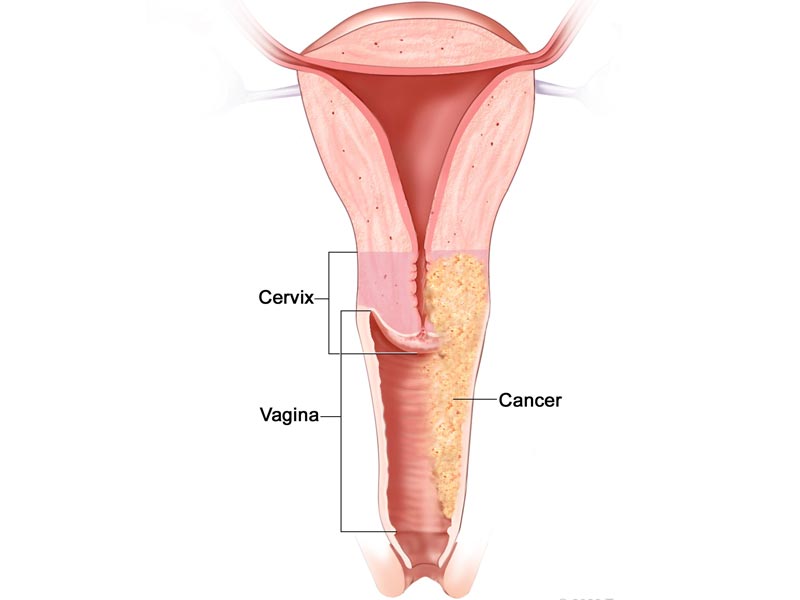 Καρκίνος του Τραχήλου της Μήτρας - Cervical Cancer