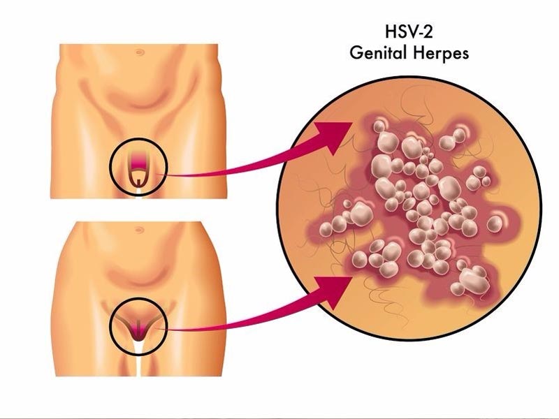 Έρπης των γεννητικών οργάνων - Genital Herpes