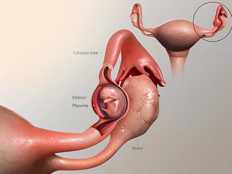 Εξωμήτριος Κύηση - Ectopic Pregnancy