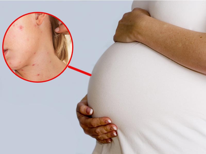 Ερυθρά και εγκυμοσύνη - (Rubella in pregnancy)